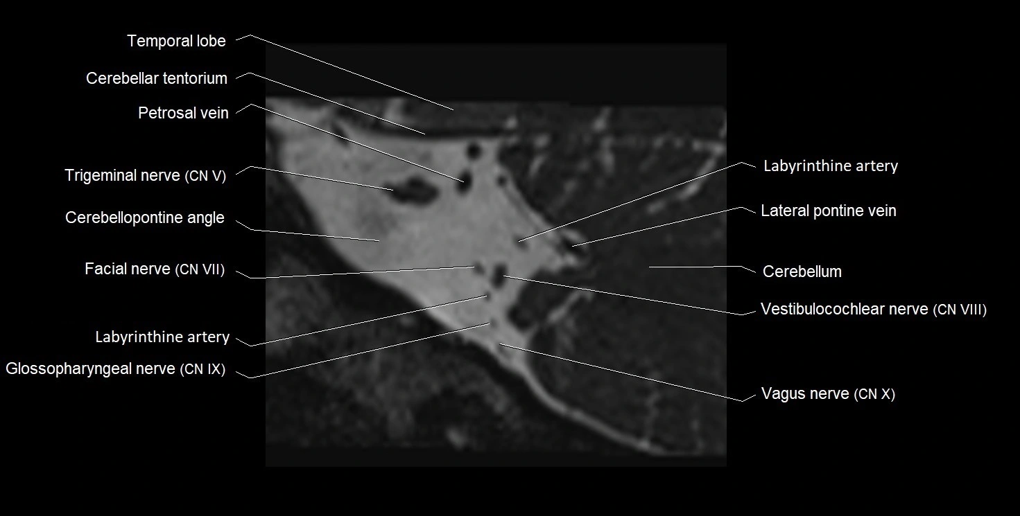 Internal auditory meatus (IAM) 3T sagittal cross sectional anatomy image 36.webp